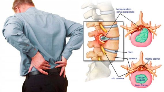 dolor lumbar remedio en clinica muñoz